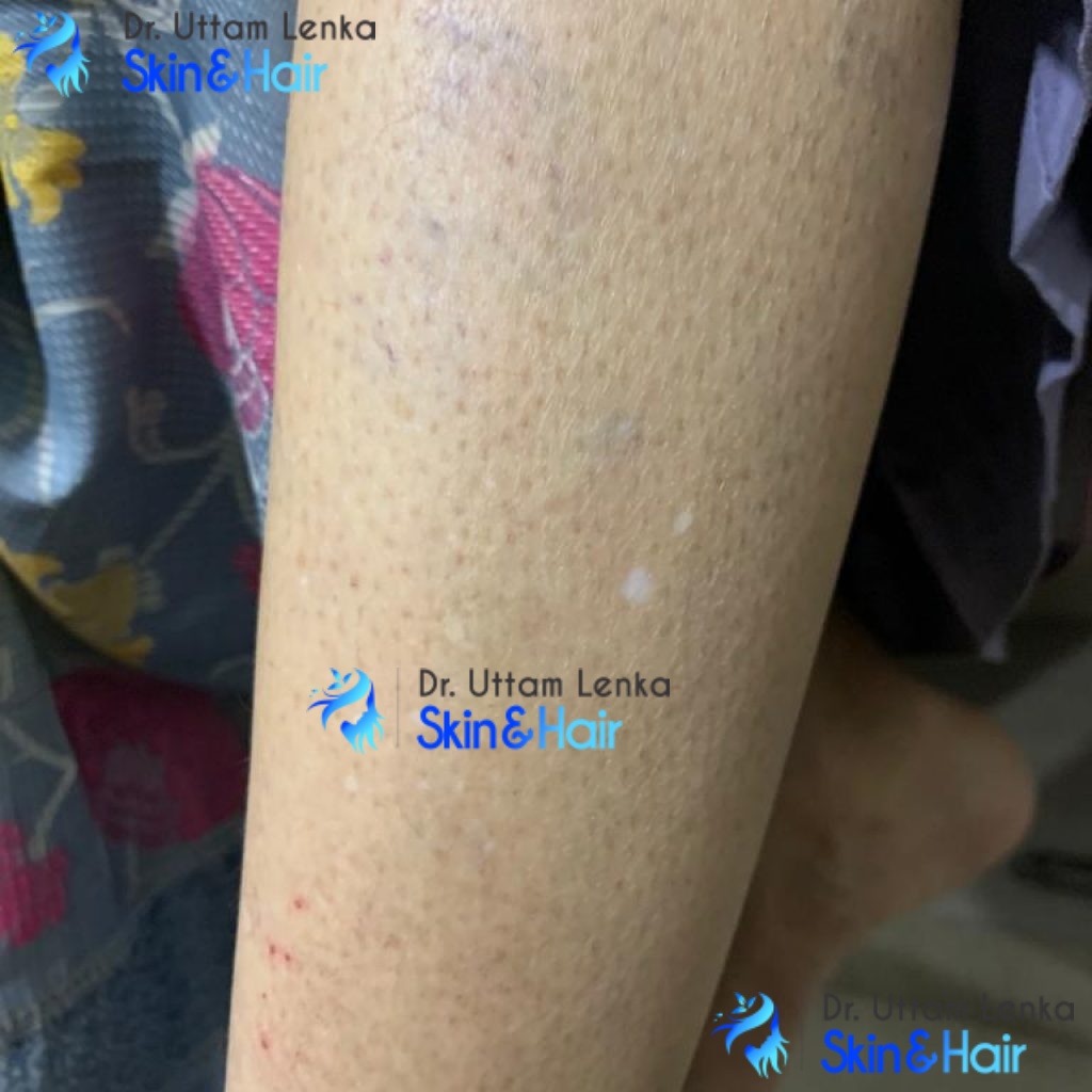 idiopathic-guttate-hypomelanosis-dr-uttam-lenka-s-skin-hair-and